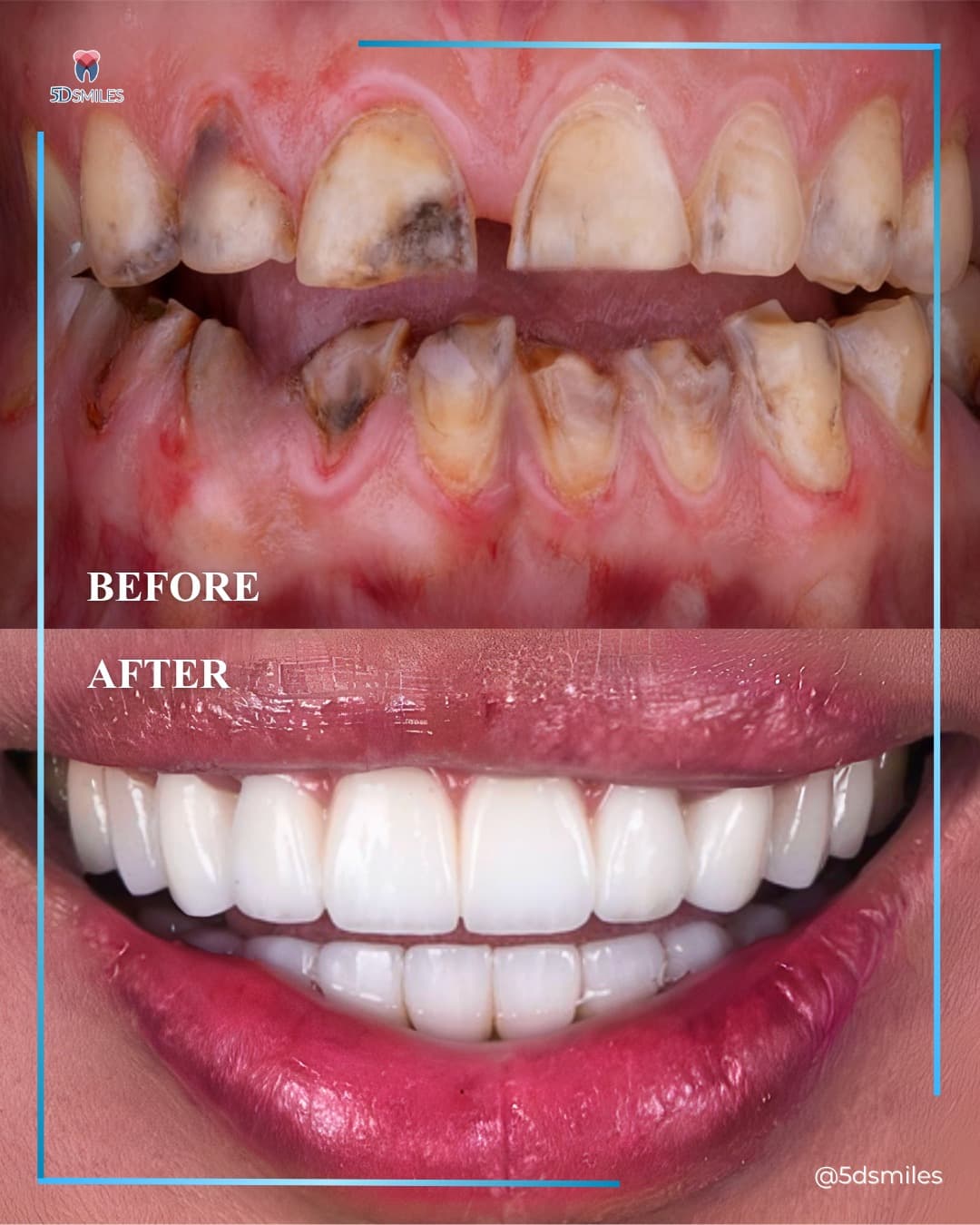 Lower All-on-6 · zirconia